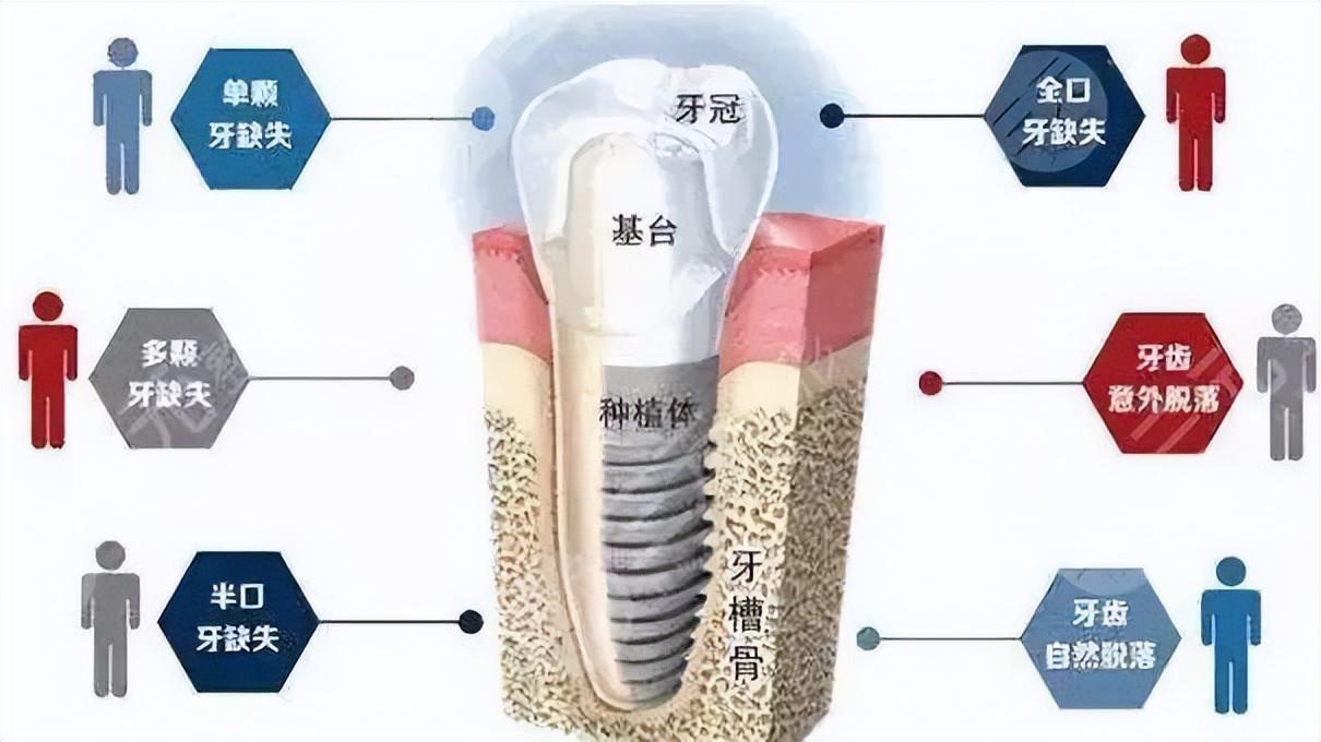 我国发布关于种植牙行业的最新扶持与规范政策解读